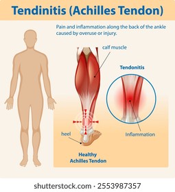 Diagram showing Achilles tendon inflammation and pain