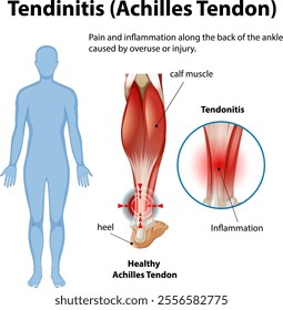 Diagram showing Achilles tendon inflammation and pain