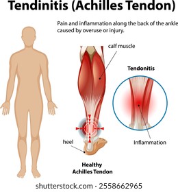 Diagram showing Achilles tendon inflammation and pain