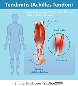 Diagram showing Achilles tendon inflammation and pain