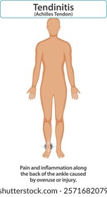 Diagram showing Achilles tendon pain and inflammation