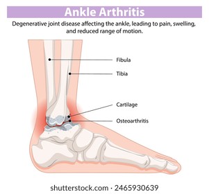 Diagram showing ankle arthritis and affected areas