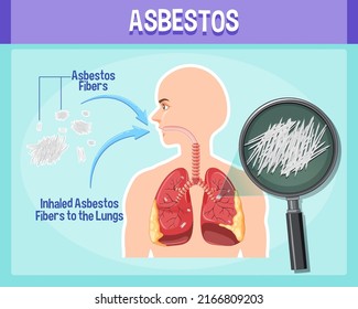 Diagram showing asbestosis in lungs illustration