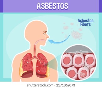 Diagram showing asbestosis in lungs illustration
