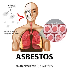 Diagram showing asbestosis in lungs illustration