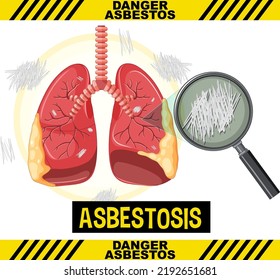 Diagram showing asbestosis in lungs illustration
