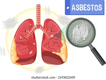 Diagram showing asbestosis in lungs illustration