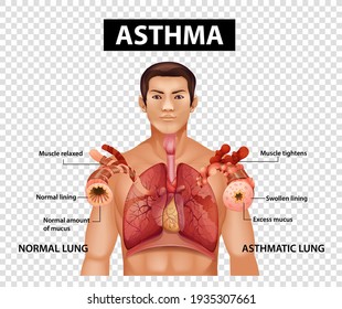 Diagram showing Asthma on transparent background illustration