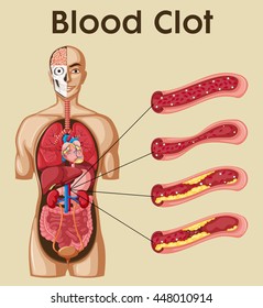 Diagram Showing Blood Clot In Human Illustration