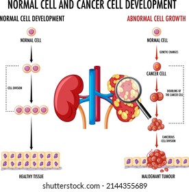 Diagrama que muestra la ilustración del proceso de desarrollo del cáncer
