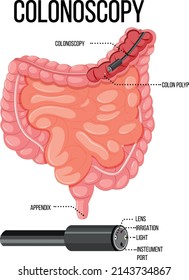 Diagram showing colonoscopy in human illustration