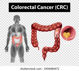 Diagram Showing Colorectal Cancer (CRC) On Transparent Background Illustration