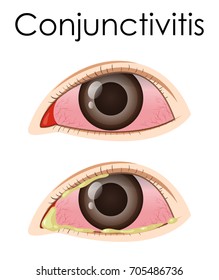 Conjunctivitis Stock Images, Royalty-Free Images & Vectors | Shutterstock