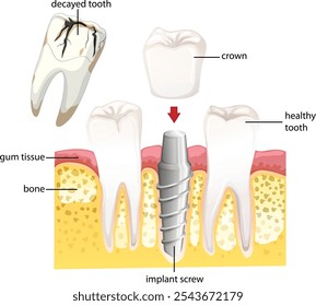 Diagrama do implante dentário e da estrutura dentária