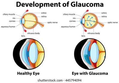 Diagram showing development of glaucoma illustration