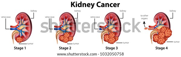 Diagram Showing Different Stages Kidney Cancer Stock Vector (Royalty ...