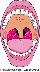 Diagram showing enlarged tonsils in a human mouth