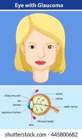 Diagram showing eye with glaucoma illustration