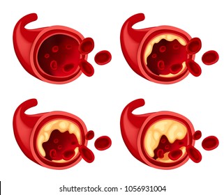 Diagram Showing Fat In Blood Illustration