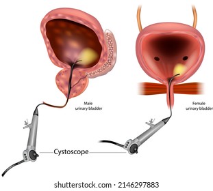 Diagram showing a Flexible cystoscopy for a man and a woman. Anatomy Male and Female Urinary Bladder. Flexible Cystoscopy - Procedure for Visually Inspecting Bladder and Urethra