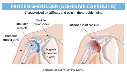 Diagram showing frozen shoulder anatomy and inflammation