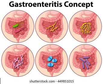 Diagram Showing Gastroenteritis Concept Illustration