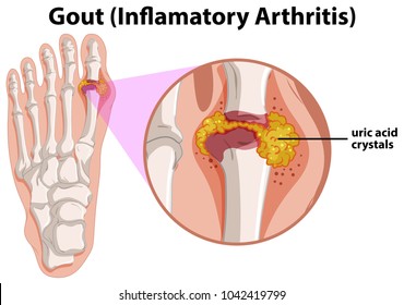 Diagram showing gout in human foot illustration