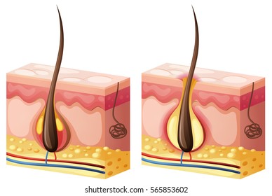 Diagram showing hair growing from skin illustration
