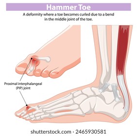 Diagram showing hammer toe deformity and PIP joint