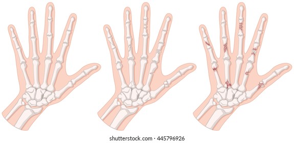 Diagram showing hand fracture illustration