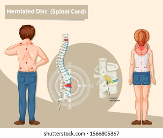 Diagram Showing Herniated Disc In Human Illustration