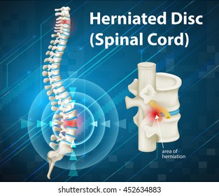 Diagram showing herniated Disc illustration