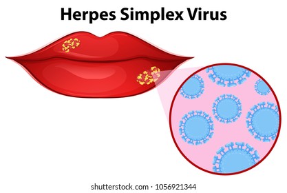 Diagram showing herpes simplex virus illustration