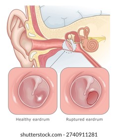 Diagram showing a hole in the eardrum due to infection or trauma. Ear Anatomy Series.