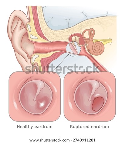 Diagram showing a hole in the eardrum due to infection or trauma. Ear Anatomy Series.