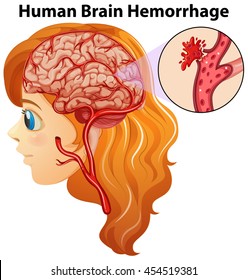 Diagram showing human brain hemorrhage illustration