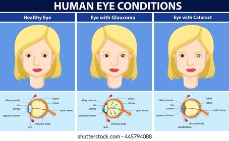 Diagram Showing Human Eye Conditions Illustration Stock Vector (Royalty ...