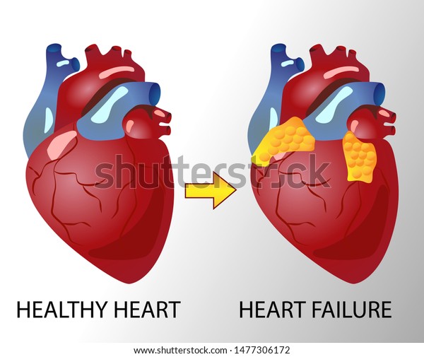 Normal heart vs Heart failure