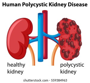 Diagram showing human polycystic kidney disease illustration