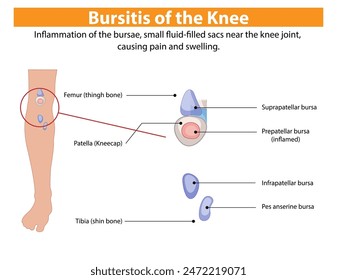 Diagram showing inflamed bursae in the knee joint