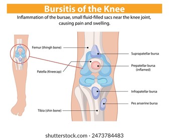 Diagram showing inflamed knee bursae and bones