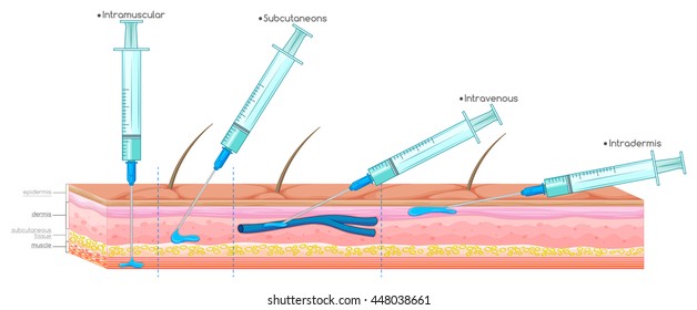 Diagram showing injection with syringe illustration