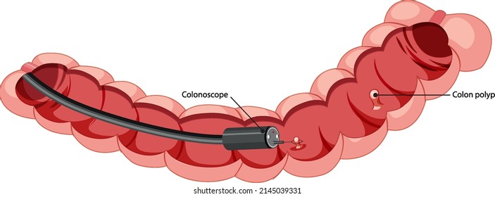 Diagram showing inside colon with colonoscope illustration