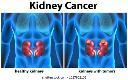 Diagram Showing Kidney Cancer In Human Illustration