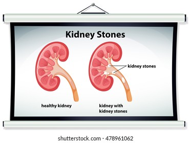 Diagram showing kidney stones illustration