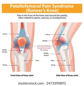 Diagrama que muestra el dolor y la inflamación de la rodilla