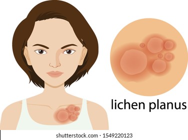 Diagram showing lichen planus on woman skin illustration