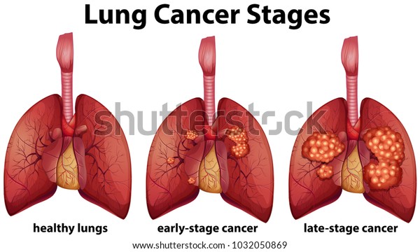 Diagram Showing Lung Cancer Stages Illustration Stock Vector (Royalty ...