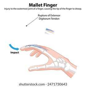 Diagram showing mallet finger injury and tendon rupture