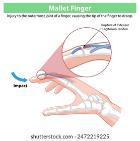 Diagram showing mallet finger injury and tendon rupture